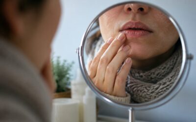 Lábios rachados e pele ressecada no inverno nem sempre são culpa apenas do frio